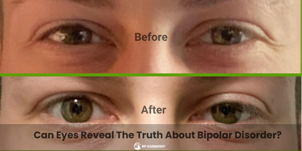 bipolar and eyes